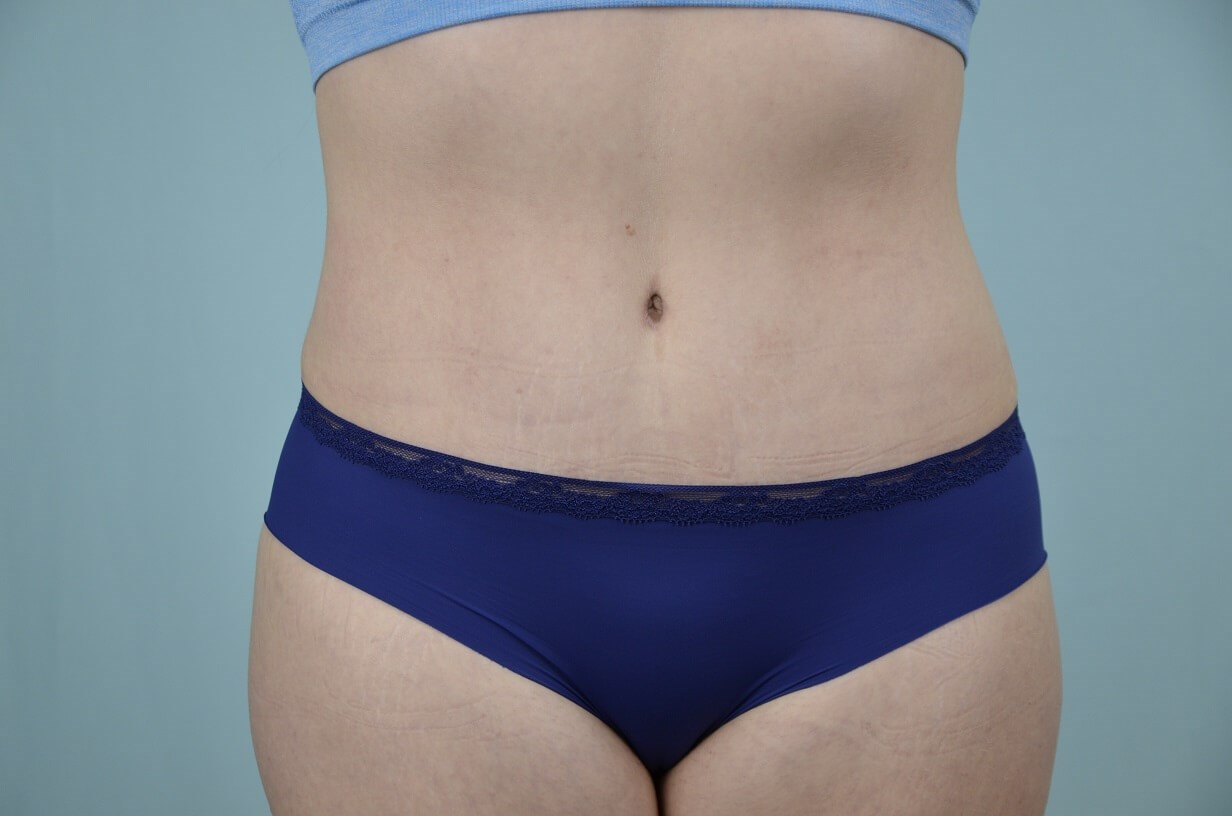 What are the hallmarks of a perfect Tummy Tuck?