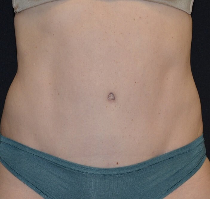 What are the hallmarks of a perfect Tummy Tuck?