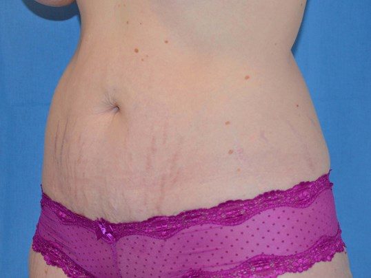 Before Image: Tummy Tuck - left-front-oblique