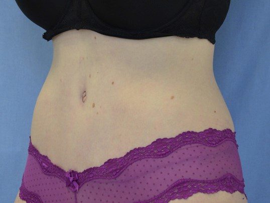 After Image: Tummy Tuck - left-front-oblique