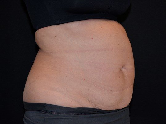 Before Image: Tummy Tuck - right-front-oblique