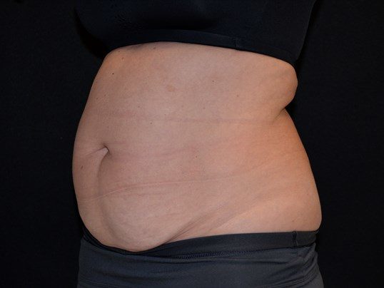 Before Image: Tummy Tuck - left-front-oblique