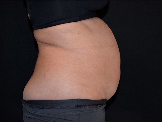 Before Image: Tummy Tuck - right-side