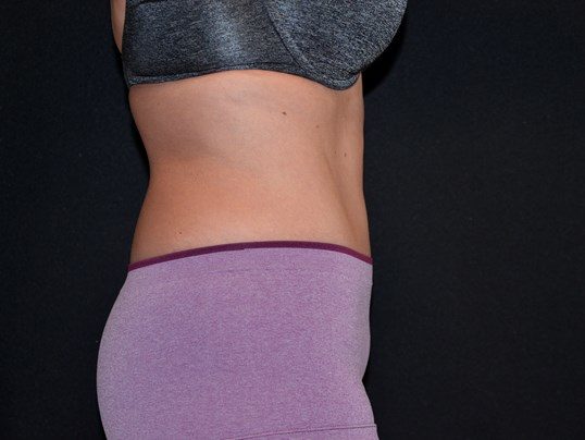 After Image: Tummy Tuck - right-side