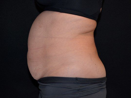 Before Image: Tummy Tuck - left-side