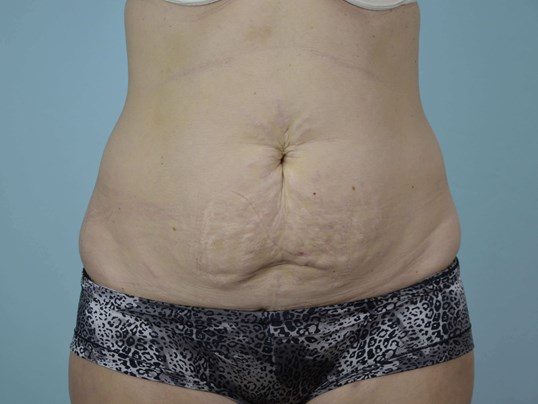 Before Image: Tummy Tuck - front