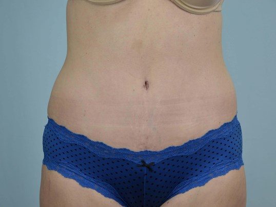 After Image: Tummy Tuck - front