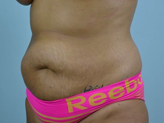 Before Image: Tummy Tuck - left-front-oblique