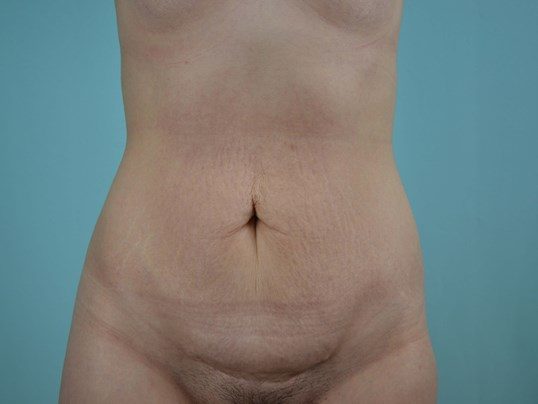 Before Image: Tummy Tuck - front