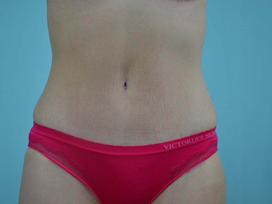 After Image: Tummy Tuck - front