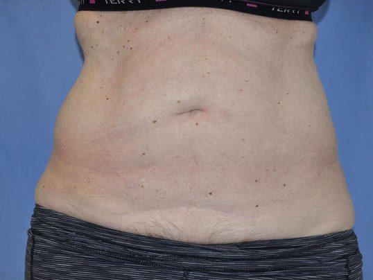 Before Image: Tummy Tuck - front