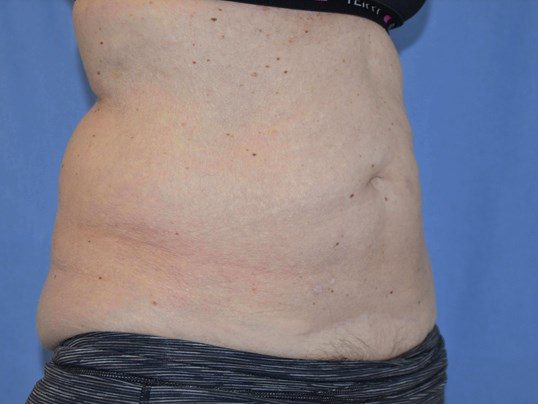 Before Image: Tummy Tuck - right-front-oblique