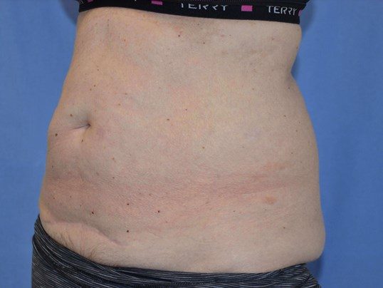 Before Image: Tummy Tuck - left-front-oblique