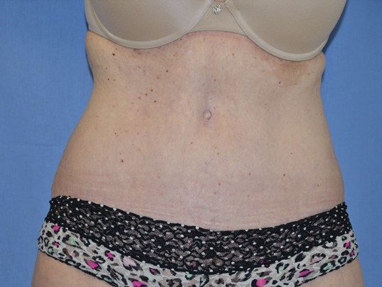 After Image: Tummy Tuck - front