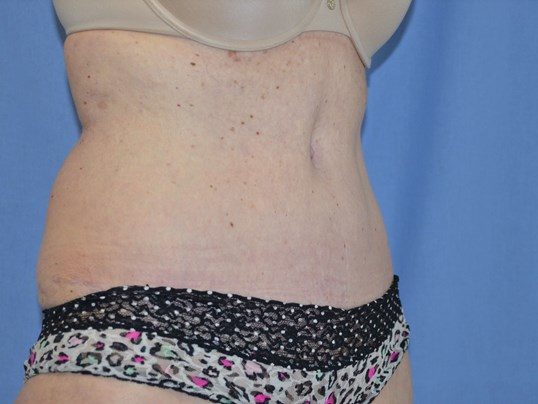 After Image: Tummy Tuck - right-front-oblique