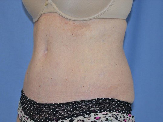 After Image: Tummy Tuck - left-front-oblique