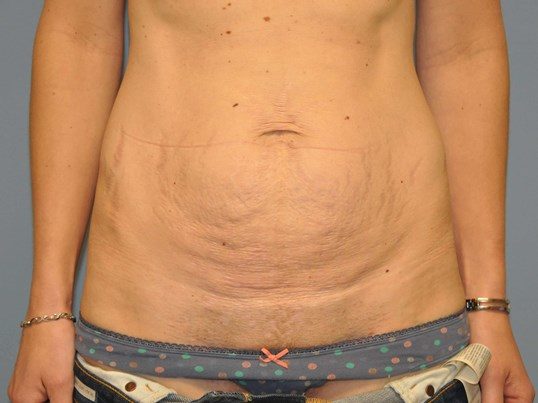 Before Image: Tummy Tuck - front