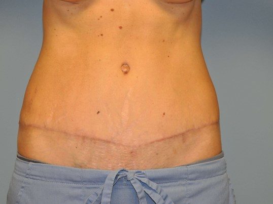 After Image: Tummy Tuck - front