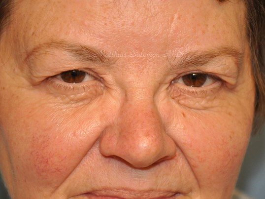 Before Image: Brow Lift - front