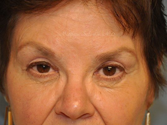 After Image: Brow Lift - front