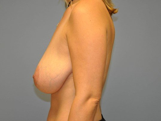 Before Image: Breast Reduction - left-side