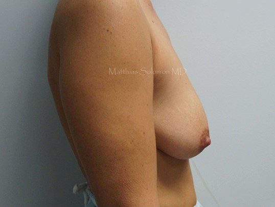 Before Image: Breast Lift - right-side