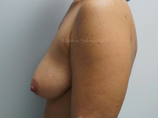 Before Image: Breast Lift - left-side