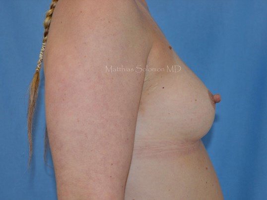 Before Image: Breast Augmentation - right-side