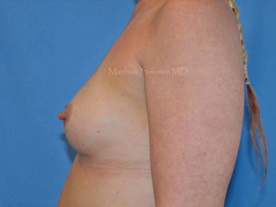 Before Image: Breast Augmentation - left-side