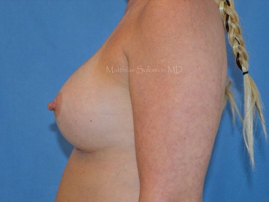 After Image: Breast Augmentation - left-side