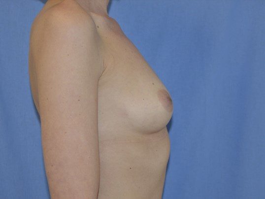 Before Image: Breast Augmentation, Breast Procedure - right-side