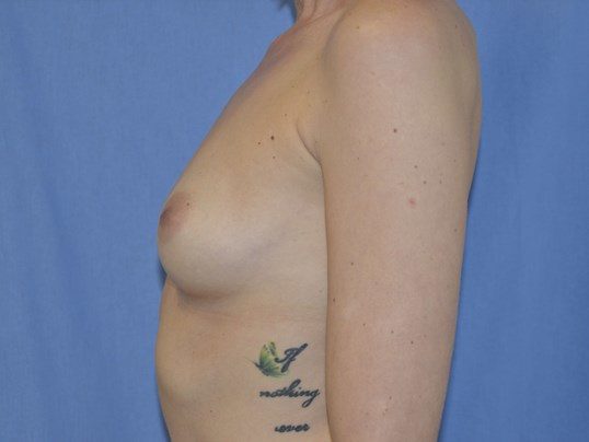 Before Image: Breast Augmentation, Breast Procedure - left-side