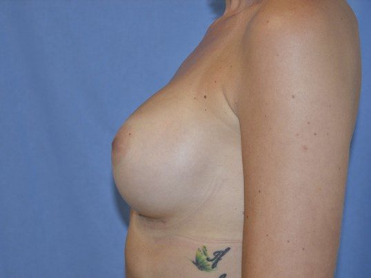 After Image: Breast Augmentation, Breast Procedure - left-side