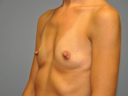 Before Image: Breast Augmentation, Breast Procedure - left-front-oblique