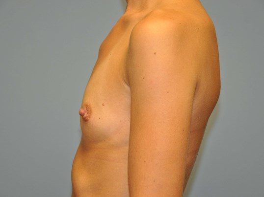 Before Image: Breast Augmentation, Breast Procedure - left-side