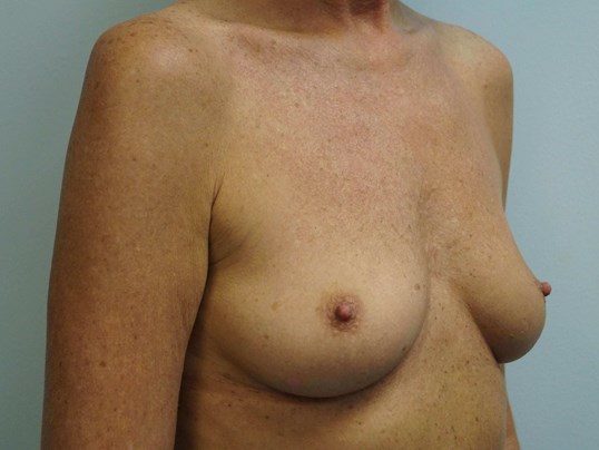 Before Image: Breast Augmentation, Breast Procedure - right-front-oblique