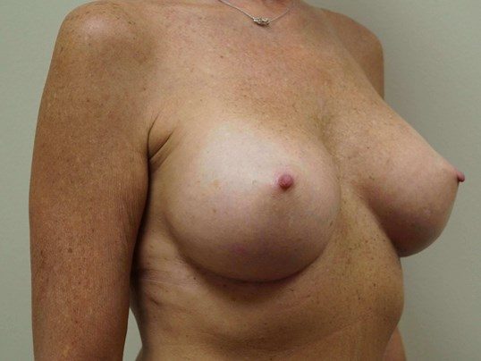 After Image: Breast Augmentation, Breast Procedure - right-front-oblique