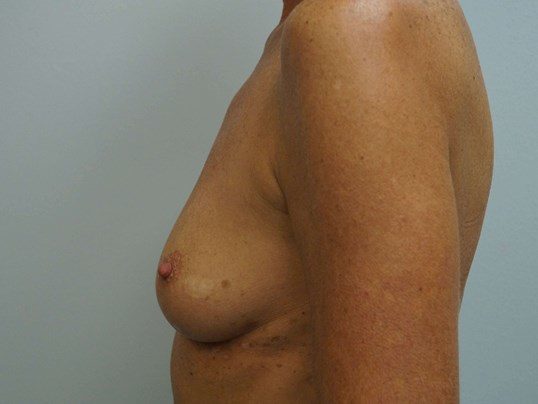 Before Image: Breast Augmentation, Breast Procedure - left-side