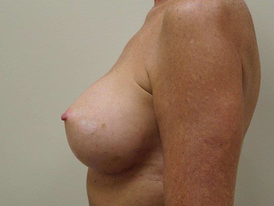 After Image: Breast Augmentation, Breast Procedure - left-side