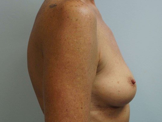 Before Image: Breast Augmentation, Breast Procedure - right-side