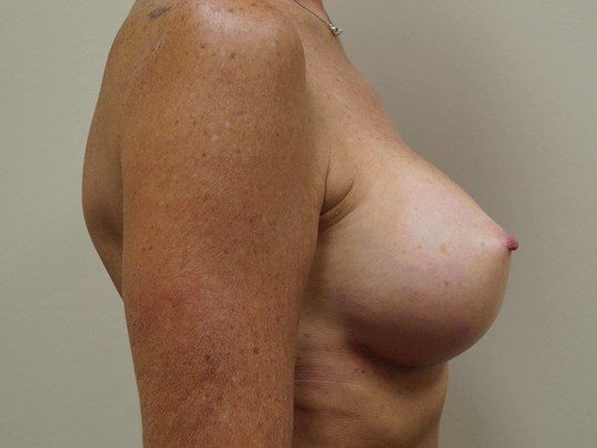 After Image: Breast Augmentation, Breast Procedure - right-side