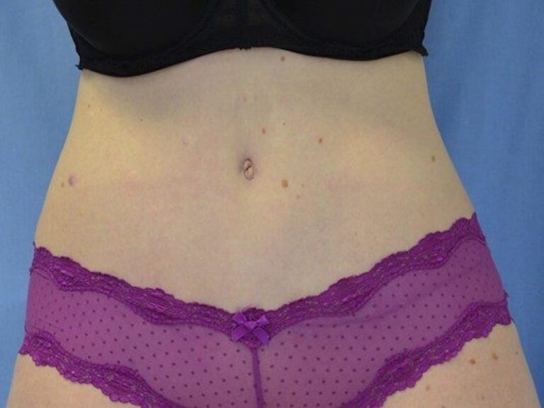 After Image: Tummy Tuck - front