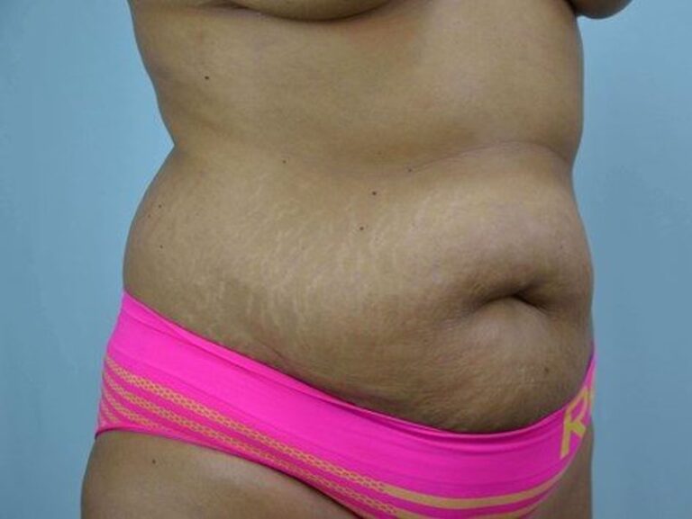 Before Image: Tummy Tuck - right-front-oblique