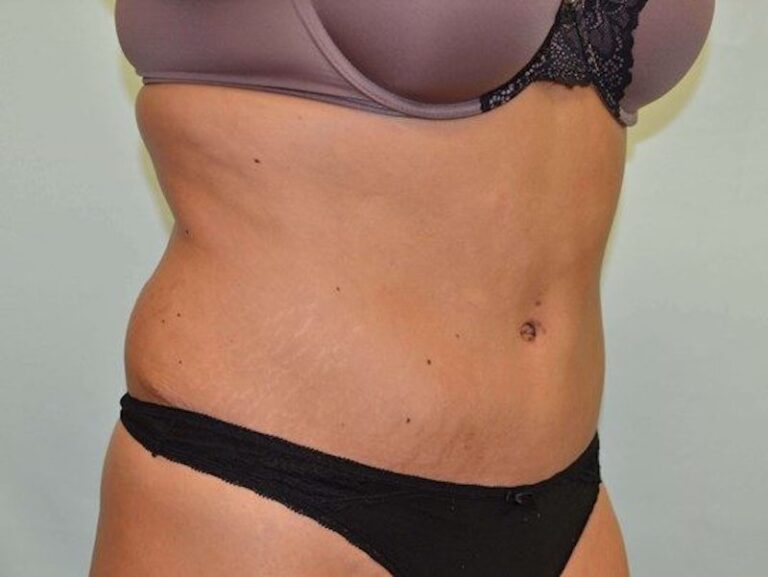 After Image: Tummy Tuck - right-front-oblique