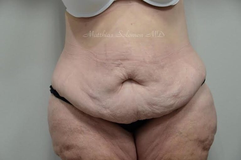 Before Image: Tummy Tuck - front