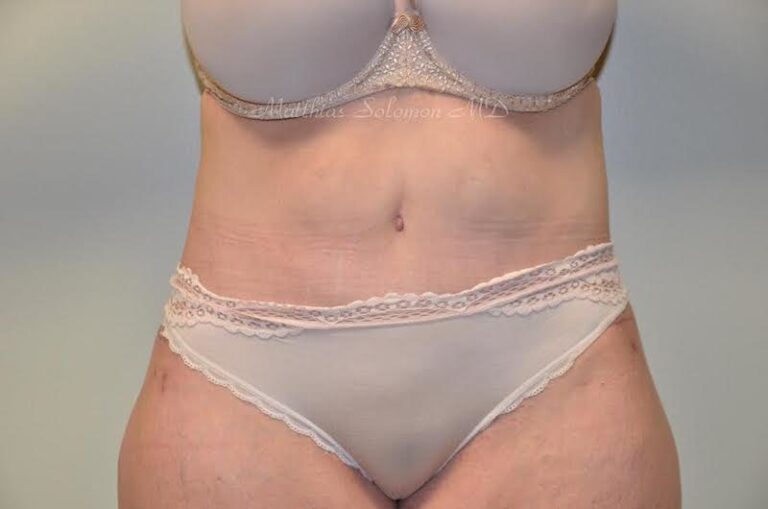 After Image: Tummy Tuck - front