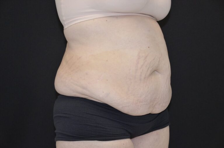 Before Image: Tummy Tuck - right-front-oblique