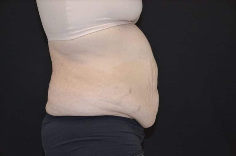 Before Image: Tummy Tuck - right-side