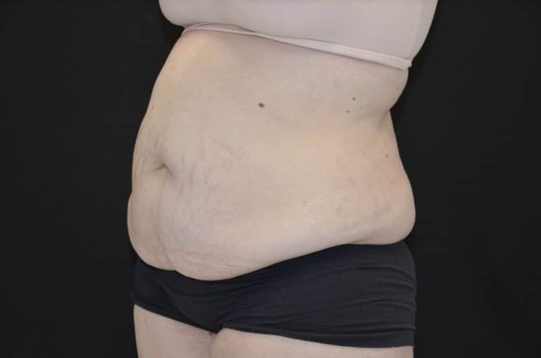 Before Image: Tummy Tuck - left-front-oblique