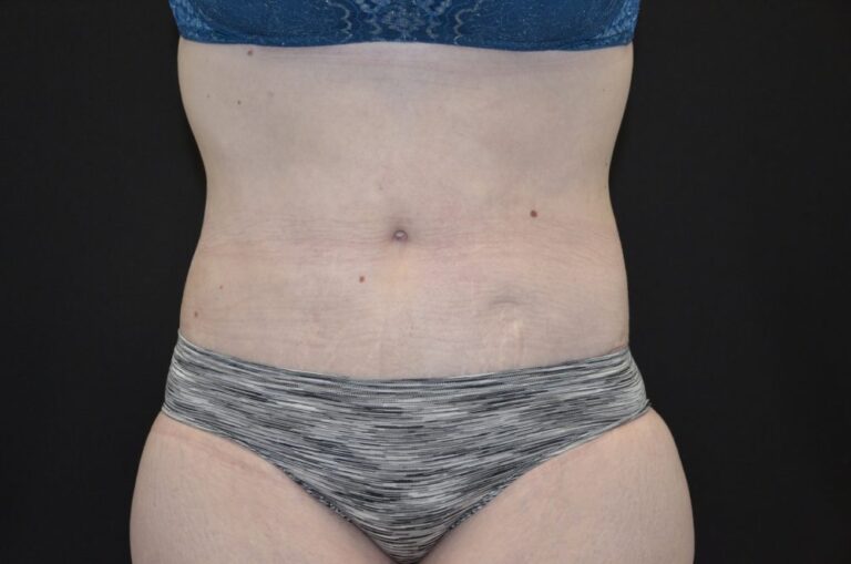 After Image: Tummy Tuck - front